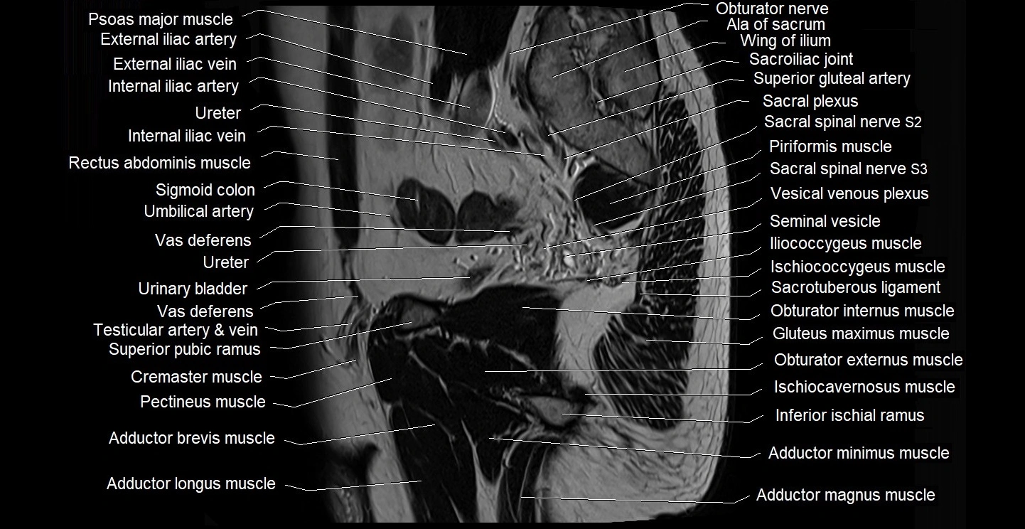 male pelvis sagittal cross sectional anatomy 3T mri image 13.webp